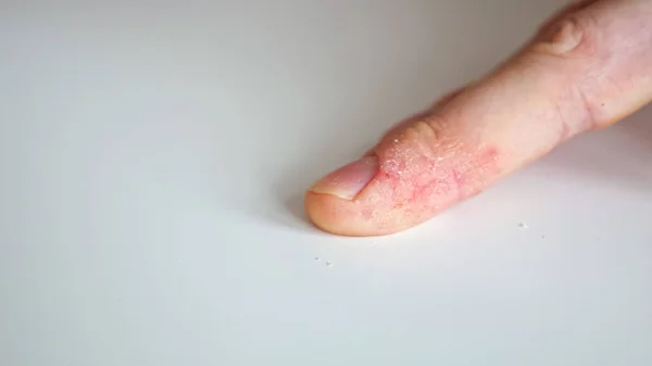 Dedos de un hombre con psoriasis y eczema — Foto de Stock