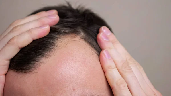 Людина з лисими плямами страждає від випадіння волосся. Лікування проблеми з волоссям — стокове фото