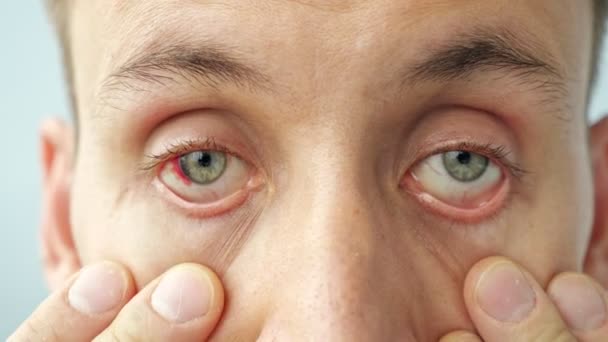 Close-up van een man met rode ogen, oogleden optillen met vingers, naar de camera kijken — Stockvideo