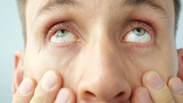 Close-up of a man with red sore eyes raising eyelids with fingers looking at the camera — Stock Video