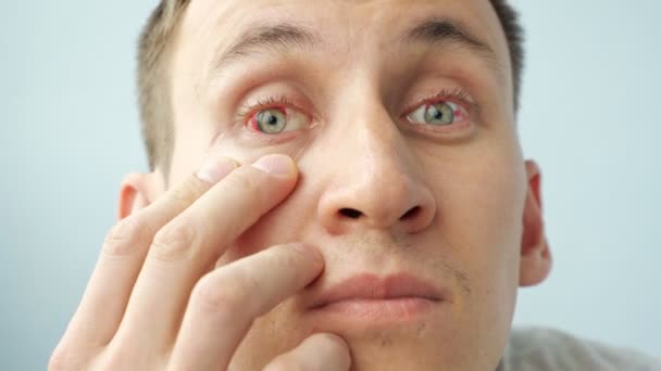 Mężczyzna z czerwonymi oczami podnoszącymi powieki palcami patrzącymi w kamerę — Wideo stockowe