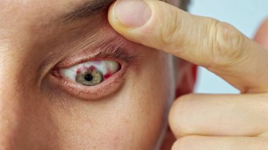 Gözü yaralı, parmakları geniş bir adamın yakın çekimi.