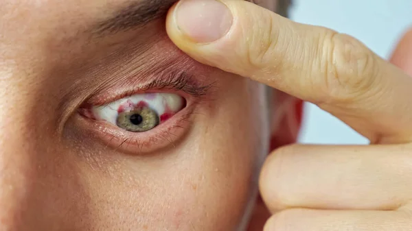 Крупним планом чоловік болить око, поширюється широкими пальцями — стокове фото