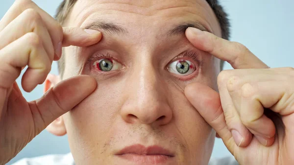 man with red eyes raising eyelids with fingers looking at the camera