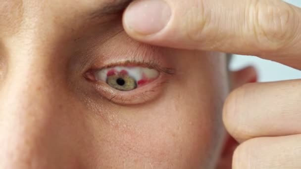 Close-up of a mans sore eye, stretched wide with fingers, slow motion — Stock Video
