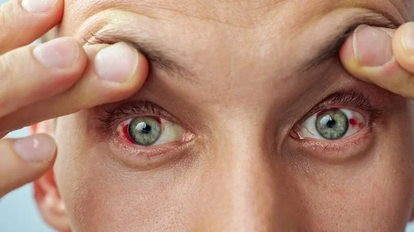 close-up of a man with red eyes, lifting eyelids with fingers, looking at the camera