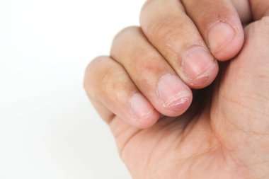 Derisi soyulmuş, beyaz arkaplanda izole edilmiş yaralı parmak yakın çekim