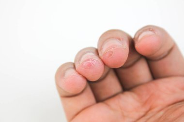 Derisi soyulmuş, beyaz arkaplanda izole edilmiş yaralı parmak yakın çekim