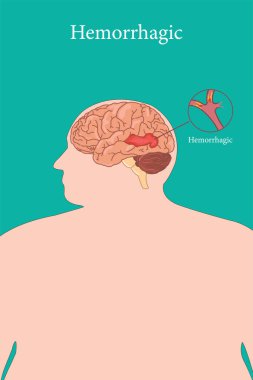 Beyin kanaması geçiren insan kafası ana hatları gösteriliyor.