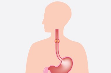İnsan gövdesi üst sindirim sisteminde özofajiyal daralma gösteriyor..