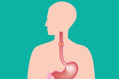 İnsan sindirim sistemi gösteriliyor, üst katmandaki yemek borusu darlığı vurgulanıyor.