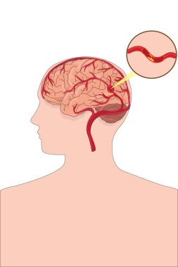 Göz alıcı beyin anevrizması insan kafasında felce neden olur.