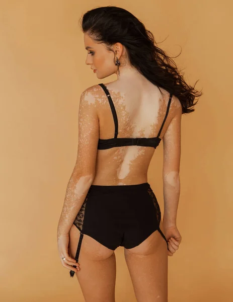 Schöne Schönheitsporträts Eines Mädchens Dessous Mit Vitiligo — Stockfoto