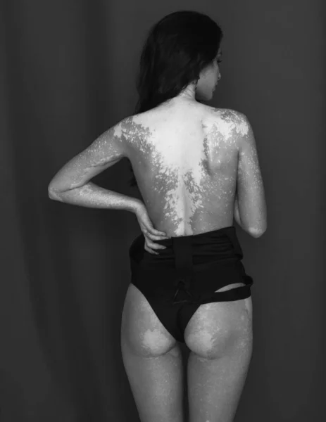 Krásné Krásné Portréty Dívky Spodním Prádle Vitiligo — Stock fotografie