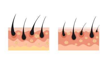 Kafa derisinin, saç kökleri, folikülleri ve deri katmanlarını gösteren bir kesit çizimi. Saç dökülmesi tedavisinde, dermatolojide ve kozmetik ürünlerde kullanılır.