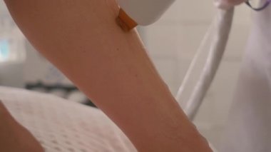 Lazerle yakın plan saç temizleme. Vücut kıllarının alınması kozmetik prosedürü