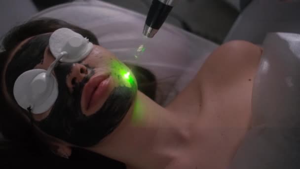 Descascamento de carbono do rosto de uma jovem menina bonita. Cosmetologia de cuidados com a pele. Terapia a laser e tratamento da pele. — Vídeo de Stock