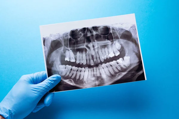 A dentist holding snapshot the patients tooth and indicates the problem. Panoramic shot of the jaw on a blue isolated background.