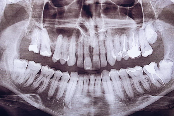 Close-up tiro panorâmico da mandíbula. Odontologia e tratamento dentário. — Fotografia de Stock