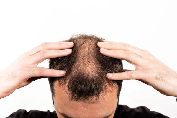 Close-up balding head of a young man on a white isolated background. — Stock Photo, Image