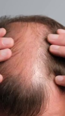 Kel ve ince saçlı, kafa derisi tutan, saç dökülmesi, saç dökülmesi, saç bakımı ve saç bakımı olan bir adamın yakın çekimi. Dikey video.