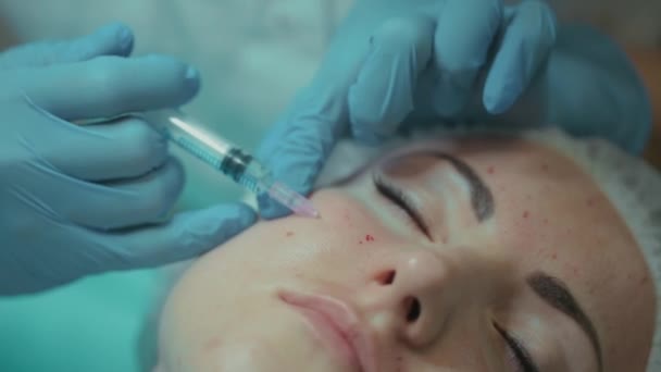 De schoonheidsspecialiste maakt een behandelingprocedure aan de patiënt. Een schoonheidsspecialiste injecteert een vrouwengezicht. Mesotherapie. Dokter in medische handschoenen geïnjecteerde injecties — Stockvideo