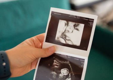 Elinde bir bebeğin 3 boyutlu görüntüsüyle basılmış bir ultrason fotoğrafı var. Hamilelik, annelik ve aile beklentilerinin sembolü..