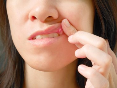 Canker sore on woman upper lip clipart