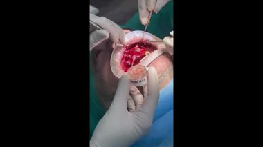 Dişçi steril klinikteki bir hastaya karmaşık diş nakli ameliyatı yapıyor.