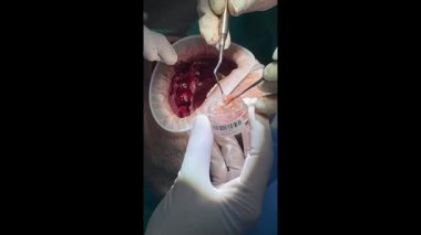 Diş cerrahı karmaşık bir oral ameliyat sırasında diş implantlarının etrafına kemik nakli malzemesi yerleştiriyor.