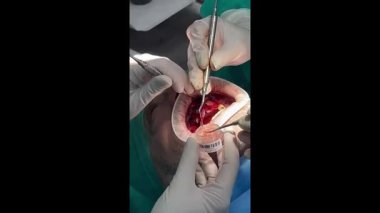 Ağız cerrahı, bir hastanın ağzına bir implant yerleştirmek için diş iliği nakli ameliyatı yapıyor.