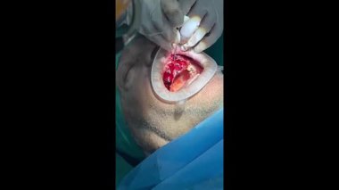 Modern bir klinik ameliyathanesinde ağız cerrahı bir hastaya karmaşık bir diş ameliyatı yapıyor.