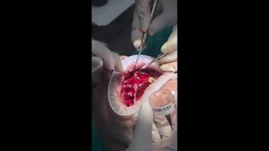 Profesyonel diş hekimi, bir kliniğe diş implantı yerleştirdikten sonra kemik nakli prosedürü uyguluyor.