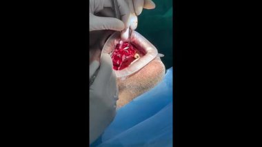 Profesyonel diş hekimi bir hastaya diş çıkarma ve çene kemiği ameliyatı yapıyor.