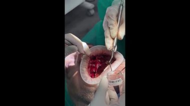 Ağız cerrahı bir kliniğe diş implantı yerleştirmek için karmaşık bir kemik nakli prosedürü uyguluyor.