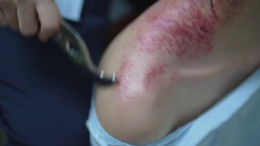 Yüzeyde morluklar olan yakın plan deri, tıbbi kıskaç ya da kıskaç ile tutuluyor..