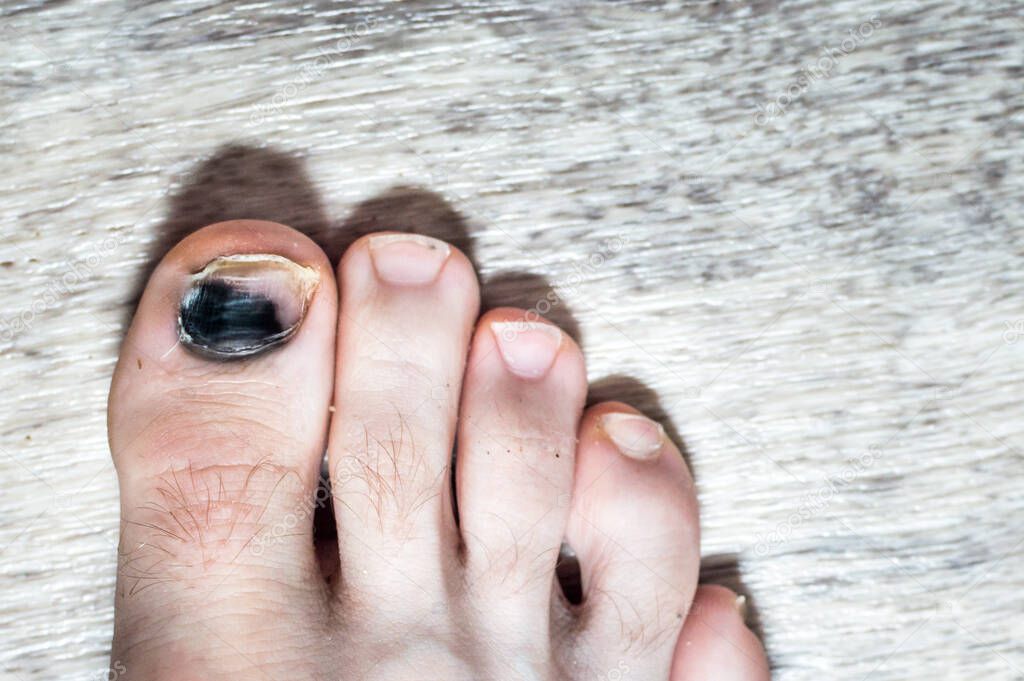 blackened nail on a man's big toe. Nail injury