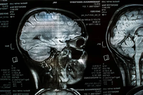 Imágenes Por Resonancia Magnética Del Cerebro Cerca Irm — Foto de Stock