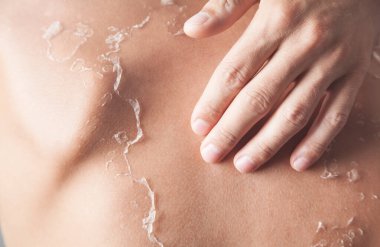 Güneş yanığından kabuğu soyulmuş bir adam..