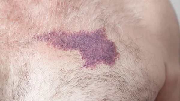 Birthmark on the skin of man.