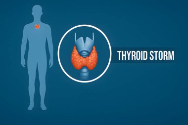 Anatomik bez detaylarıyla tiroid fırtınasının görsel tasviri, endokrin eğitim ve farkındalık kampanyaları için ideal.