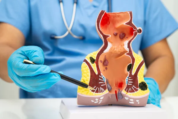 Hastanede rektum ve hemoroit insan anatomisi modeli olan Asyalı bir doktor vasküler yapısında iltihaplanma var..
