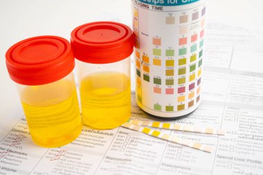 İdrar tahlili, reaksiyonlu idrar kabı. PH kağıt testi ve karşılaştırma tablosu laboratuvarda..