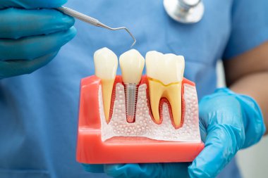 Diş implantı tutan diş hekimi, çeneye yapay diş kökleri, diş tedavisi kanal tedavisi, diş eti hastalığı, dişçi için diş modeli.