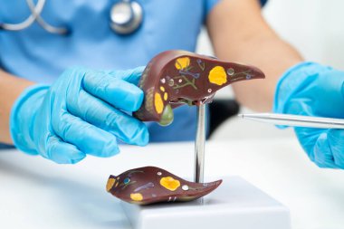 Dünya Hepatit Günü 'nde siroz, karaciğer kanseri, yağlı karaciğer, karaciğer anatomisi olan Asyalı doktor..