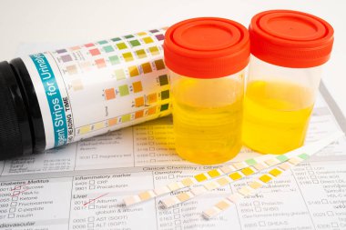 İdrar tahlili, reaksiyonlu idrar kabı. PH kağıt testi ve karşılaştırma tablosu laboratuvarda..