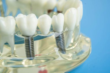 Diş implantı, çeneye yapay diş kökleri, diş tedavisinin kök kanalı, diş eti hastalığı, diş hekimliği üzerine çalışan dişçi modeli.