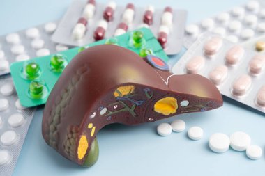 Hap tedavisi gören karaciğer modeli, siroz, karaciğer kanseri, yağlı karaciğer..