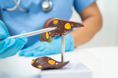 Dünya Hepatit Günü 'nde siroz, karaciğer kanseri, yağlı karaciğer, karaciğer anatomisi olan Asyalı doktor..