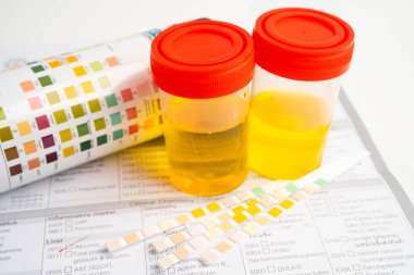 İdrar tahlili, reaksiyonlu idrar kabı. PH kağıt testi ve karşılaştırma tablosu laboratuvarda..